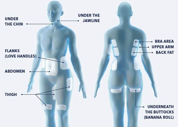 CoolSculpting Areas